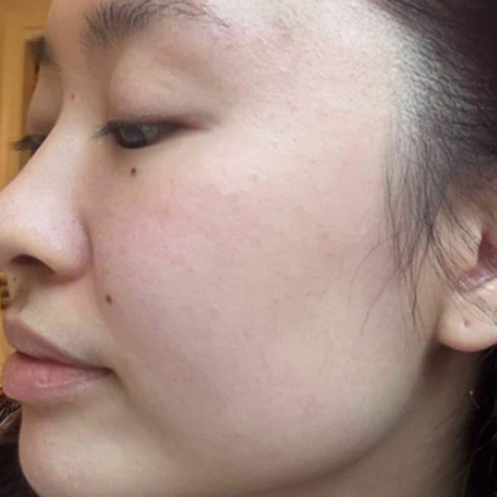 Side of the face, before and after — after