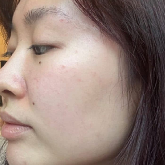 Side of the face, before and after — before