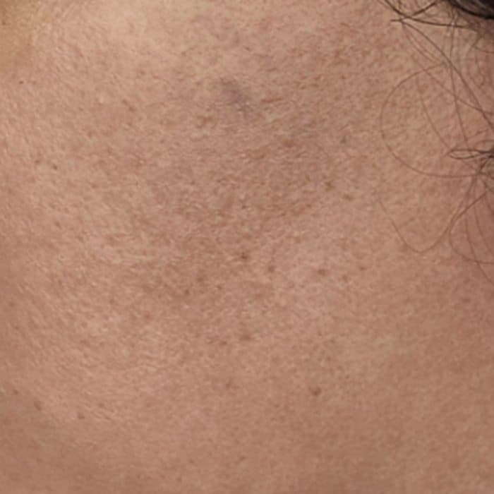 Cheek showing surface texture, before and after — after