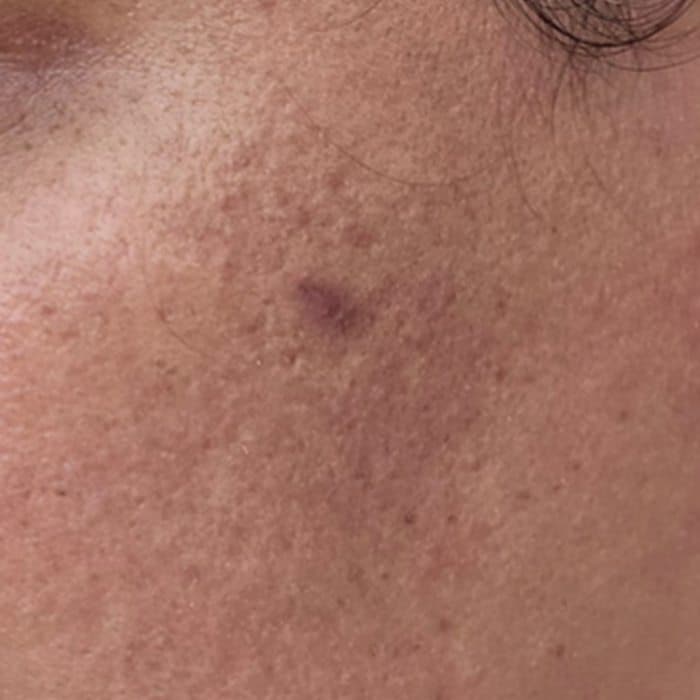 Cheek showing surface texture, before and after — before