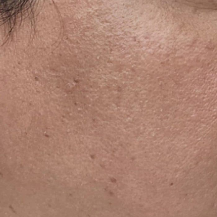 Cheek and jawline, before and after — before