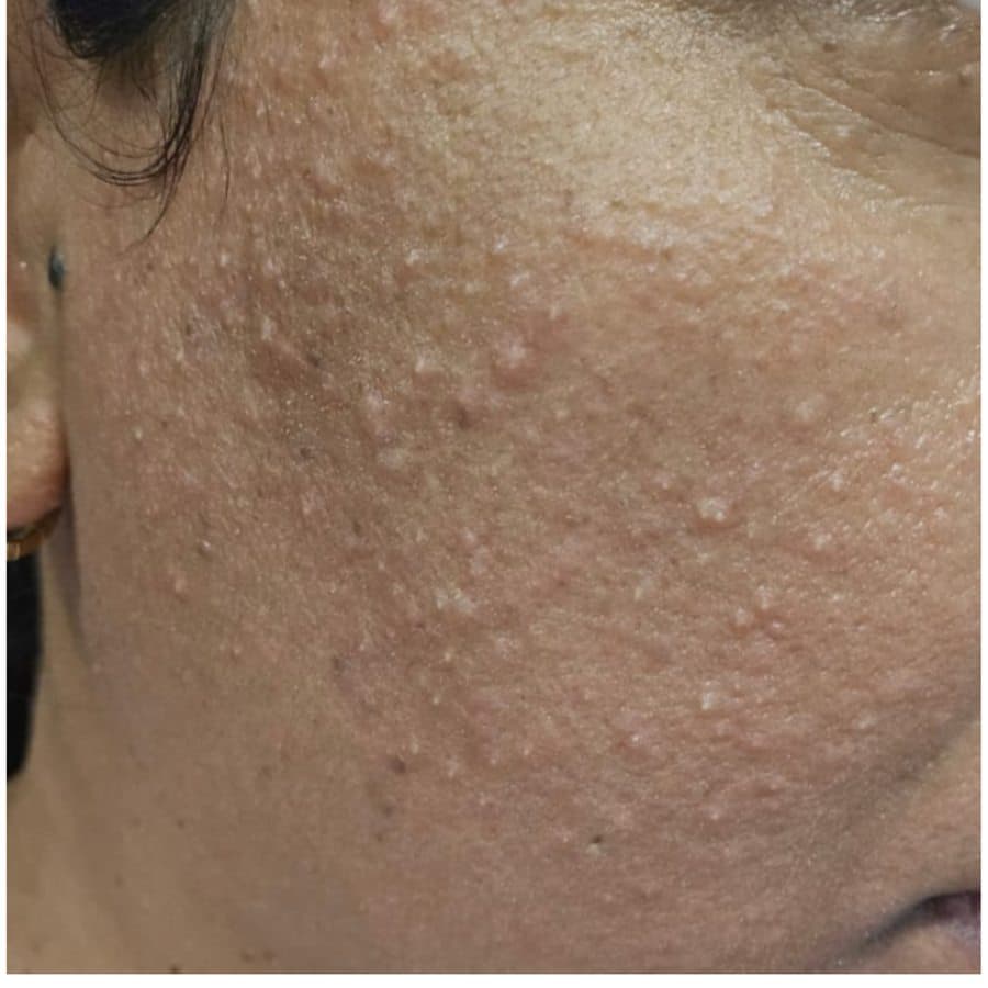 Cheek and jawline, before and after eighteen days of use — before